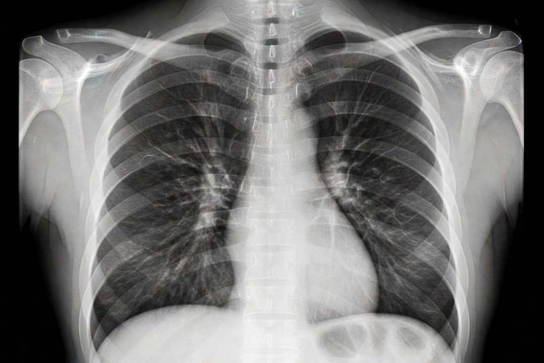 Illustrative frontal chest X-ray preview